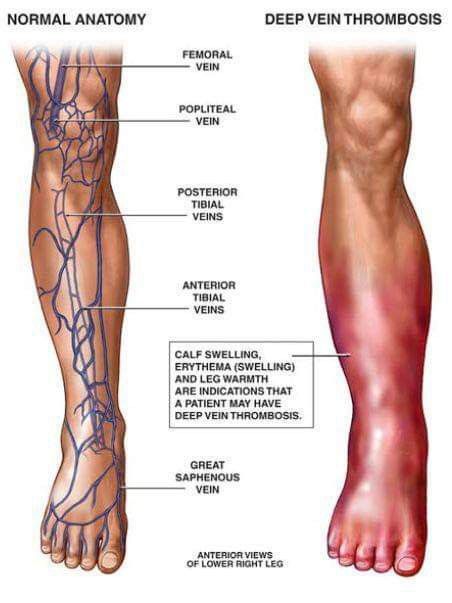 VAI TRÒ CỦA D-dimer TRONG CHẨN ĐOÁN   THUYÊN TẮC HUYẾT KHỐI TĨNH MẠCH